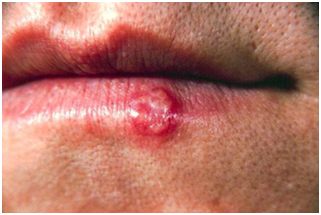 herpes