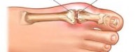 داروهای موثر بر نقرس در طب سنتی ایرانی