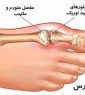 داروهای موثر بر نقرس در طب سنتی ایرانی