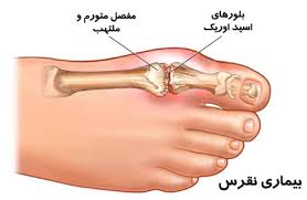 داروهای موثر بر نقرس در طب سنتی ایرانی